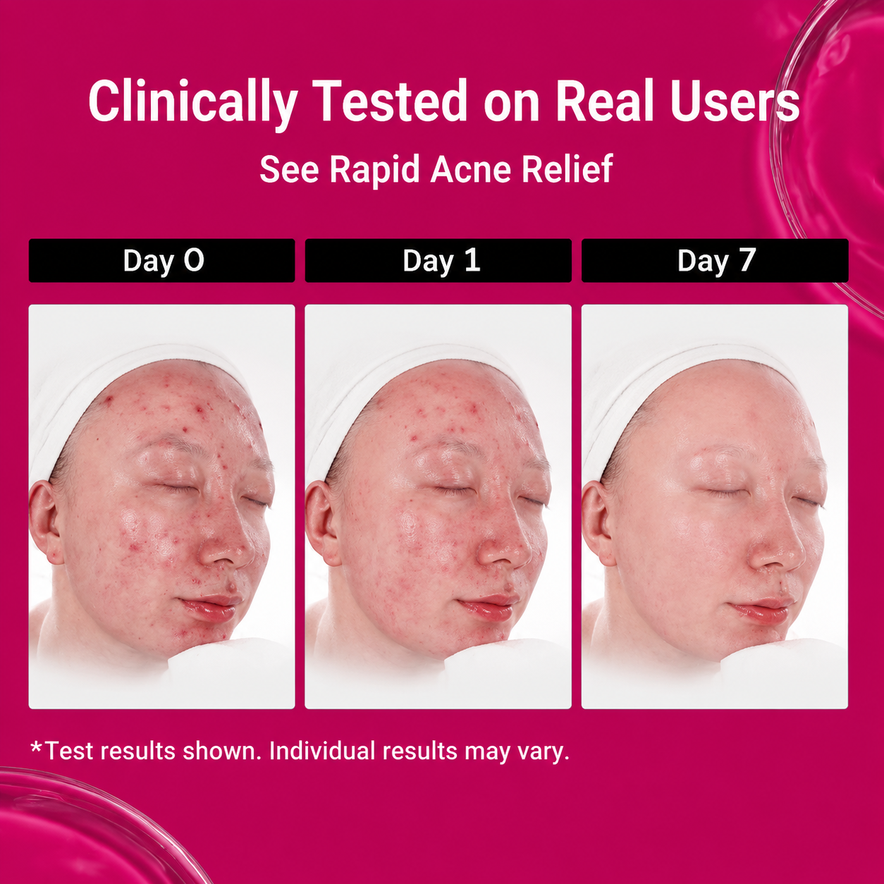 Acne Drying Lotion