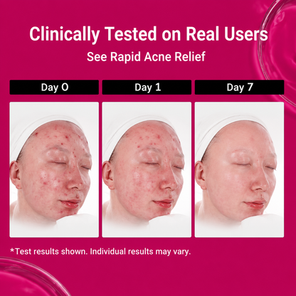 Acne Drying Lotion