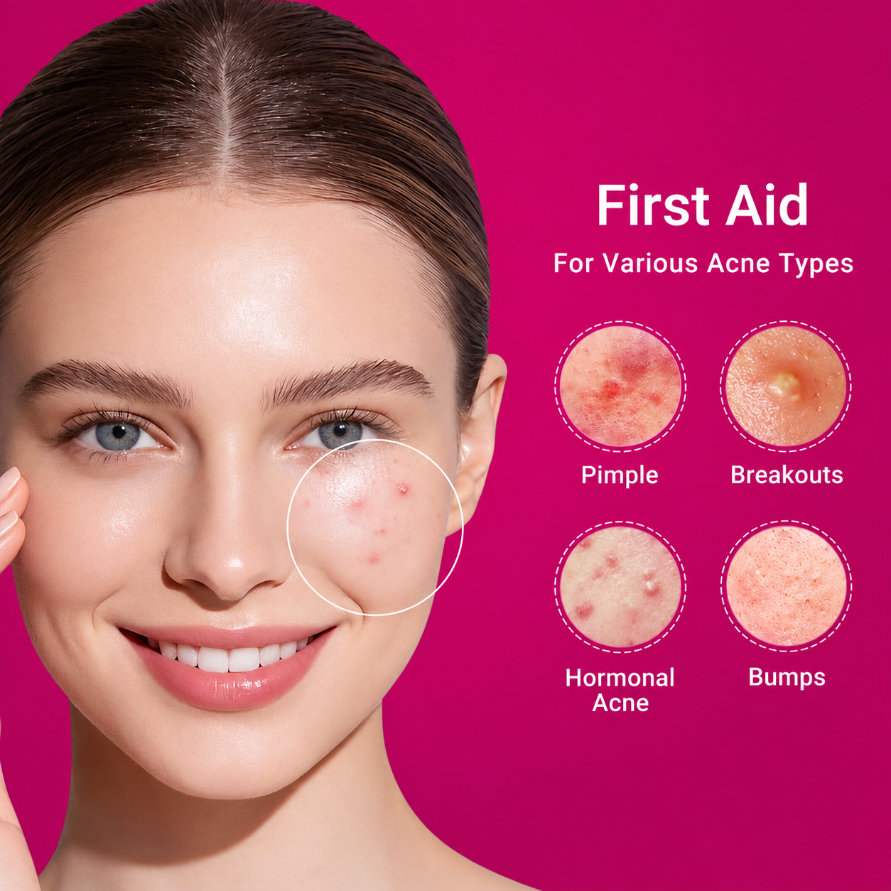 Acne Drying Lotion